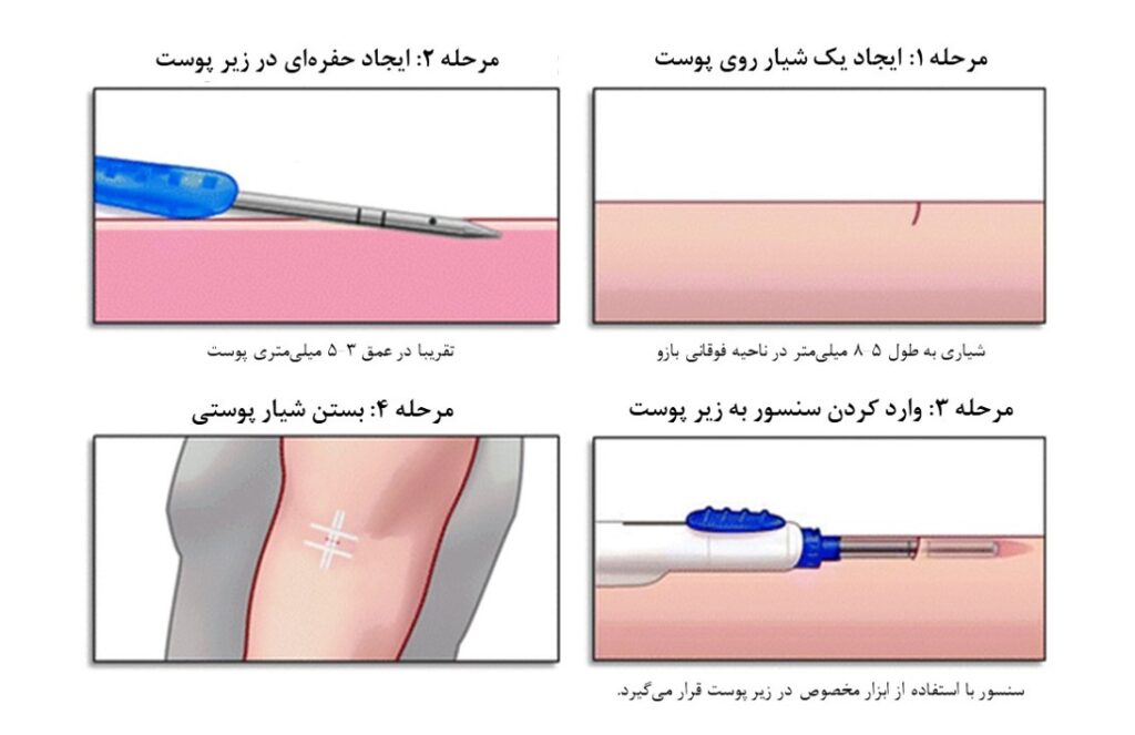 مراحل نصب اورسنس