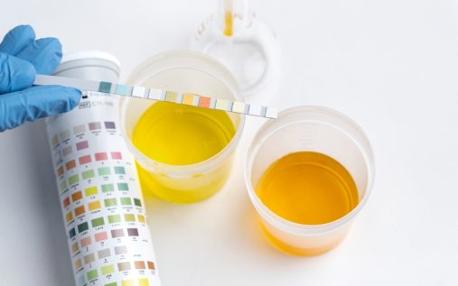 کتواسیدوز دیابتی