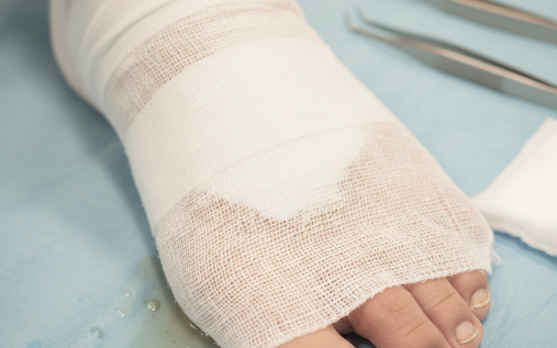 درمان زخم پای دیابتی